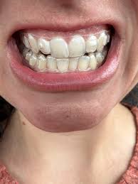 A smile wearing clear aligners